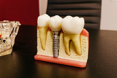 front teeth implants